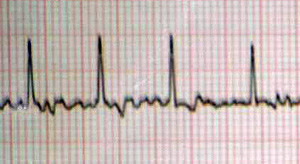 atrial fibrilation ecg
